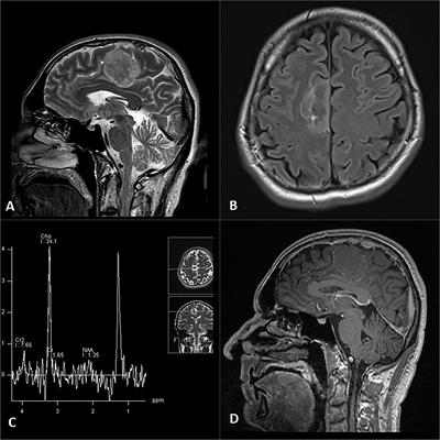 Case Report: Atypical Solitary Brain Metastasis: The Role of MR Spectroscopy In Differential Diagnosis